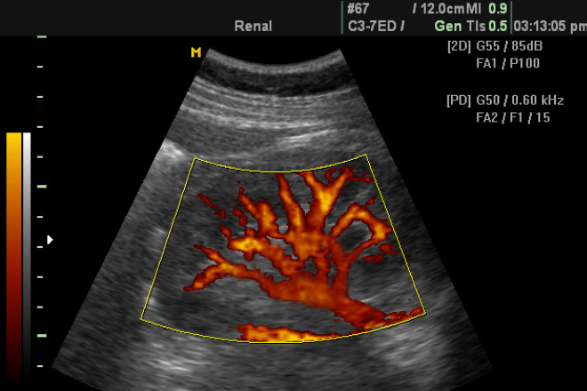 Doppler Abdominal